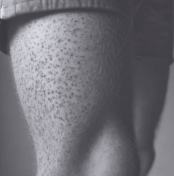 I don’t like your freckles